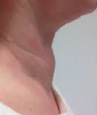 tireoide depois da Ablação