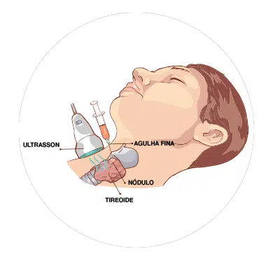 biopsia tireoide