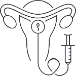 embolização de mioma uterino