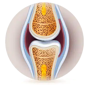 joelho com osteoartrite