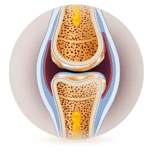 joelho com osteoartrite