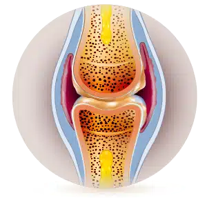 joelho com osteoartrite