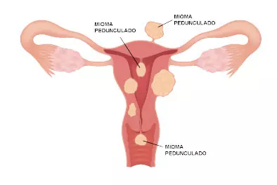 miomas uterino pediculado
