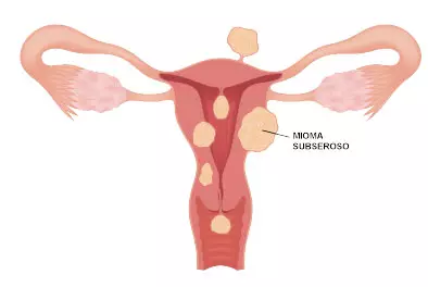 mioma uterino subseroso