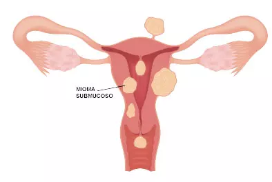 miomas uterino submucoso