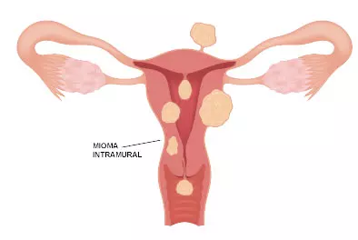 miomas uterino intramural