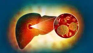 Carcinoma Hepatocelular