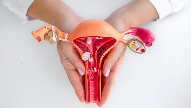 leiomioma uterino