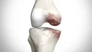 artrose