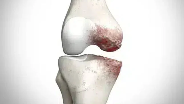 artrose